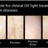 High Power Focused Xenon Chloride Handheld Xecl Excimer 308nm Laser Vitiligo Light Therapy - Image 10